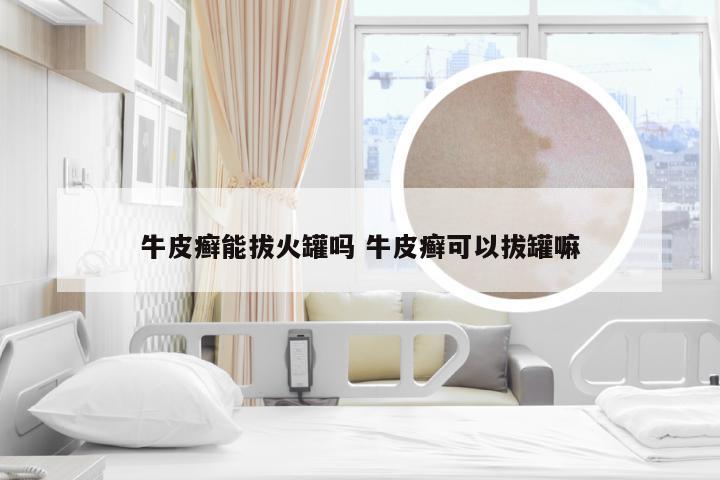 牛皮癣能拔火罐吗 牛皮癣可以拔罐嘛