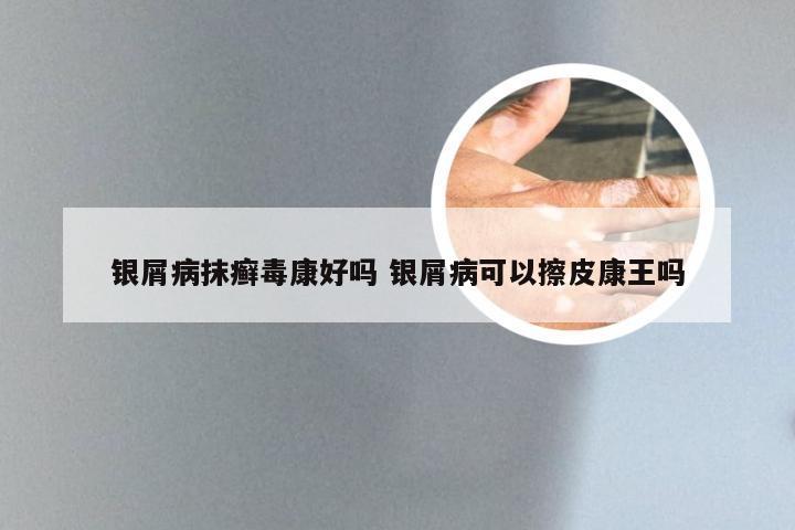 银屑病抹癣毒康好吗 银屑病可以擦皮康王吗