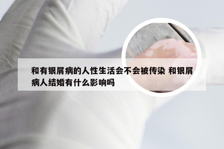 和有银屑病的人性生活会不会被传染 和银屑病人结婚有什么影响吗