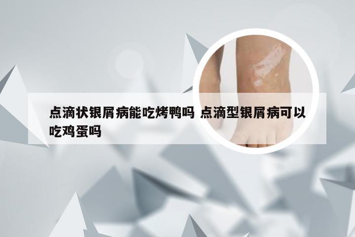 点滴状银屑病能吃烤鸭吗 点滴型银屑病可以吃鸡蛋吗