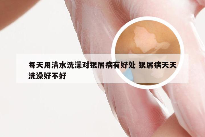每天用清水洗澡对银屑病有好处 银屑病天天洗澡好不好