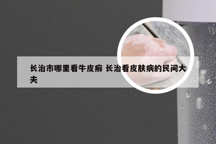 长治市哪里看牛皮癣 长治看皮肤病的民间大夫