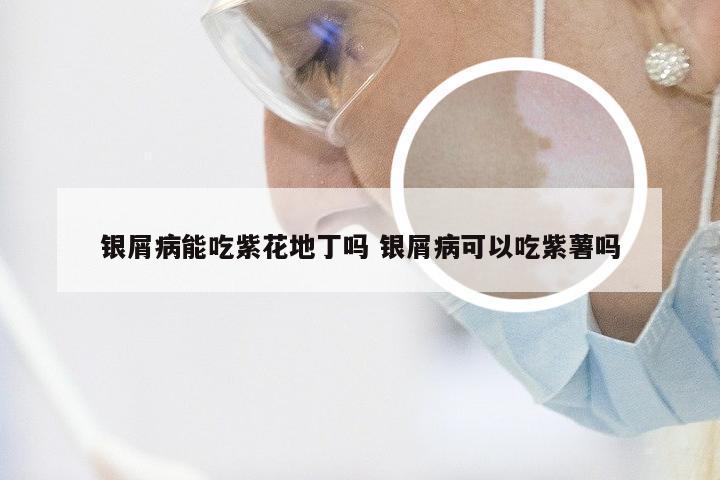 银屑病能吃紫花地丁吗 银屑病可以吃紫薯吗