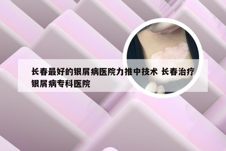 长春最好的银屑病医院力推中技术 长春治疗银屑病专科医院