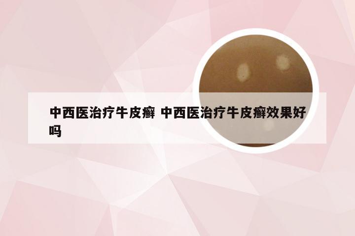 中西医治疗牛皮癣 中西医治疗牛皮癣效果好吗