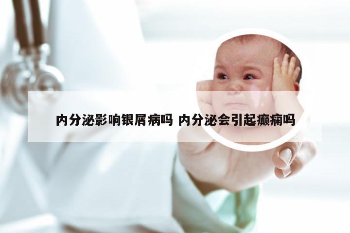 内分泌影响银屑病吗 内分泌会引起癫痫吗