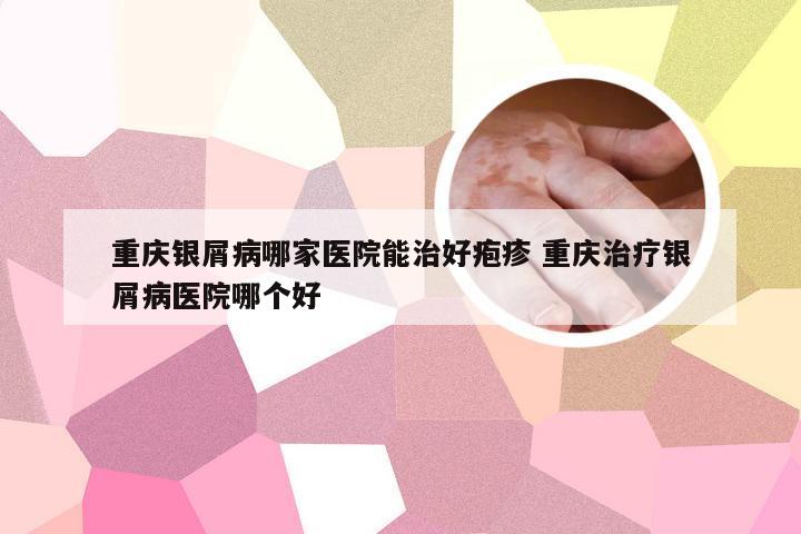 重庆银屑病哪家医院能治好疱疹 重庆治疗银屑病医院哪个好
