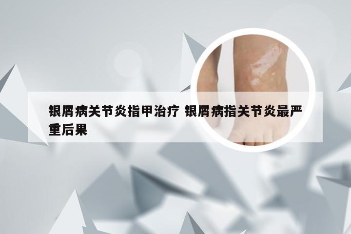 银屑病关节炎指甲治疗 银屑病指关节炎最严重后果