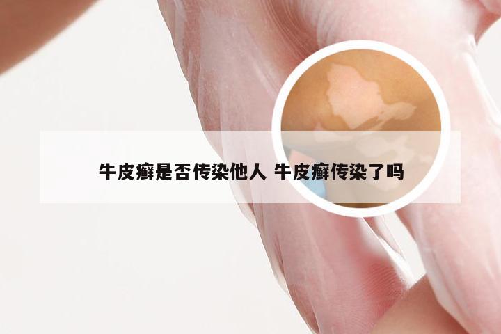 牛皮癣是否传染他人 牛皮癣传染了吗