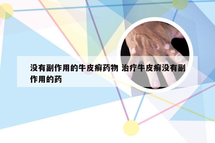 没有副作用的牛皮癣药物 治疗牛皮癣没有副作用的药