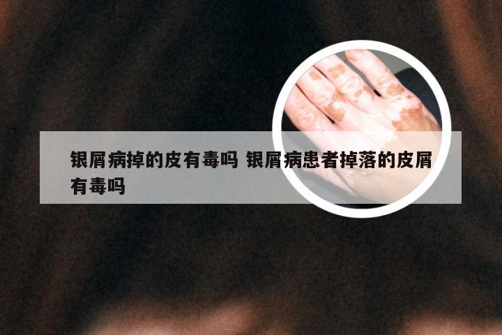 银屑病掉的皮有毒吗 银屑病患者掉落的皮屑有毒吗