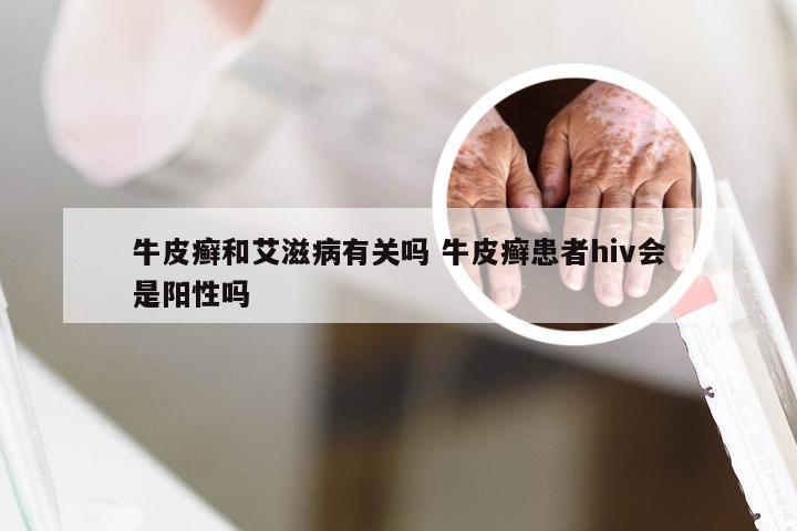 牛皮癣和艾滋病有关吗 牛皮癣患者hiv会是阳性吗
