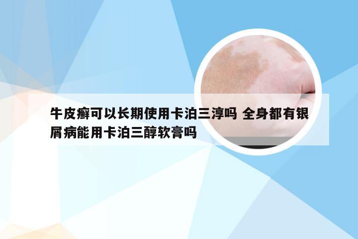 牛皮癣可以长期使用卡泊三淳吗 全身都有银屑病能用卡泊三醇软膏吗