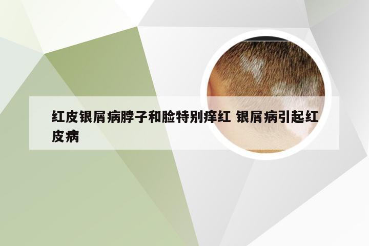 红皮银屑病脖子和脸特别痒红 银屑病引起红皮病
