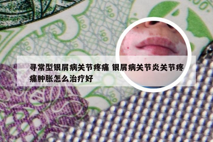 寻常型银屑病关节疼痛 银屑病关节炎关节疼痛肿胀怎么治疗好