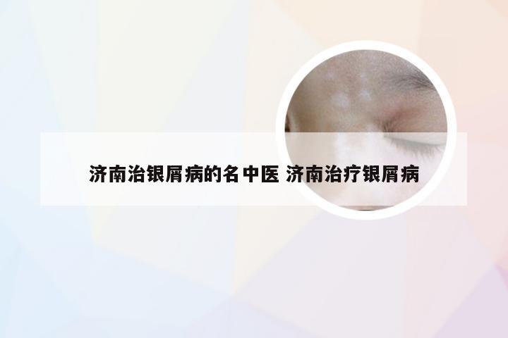 济南治银屑病的名中医 济南治疗银屑病