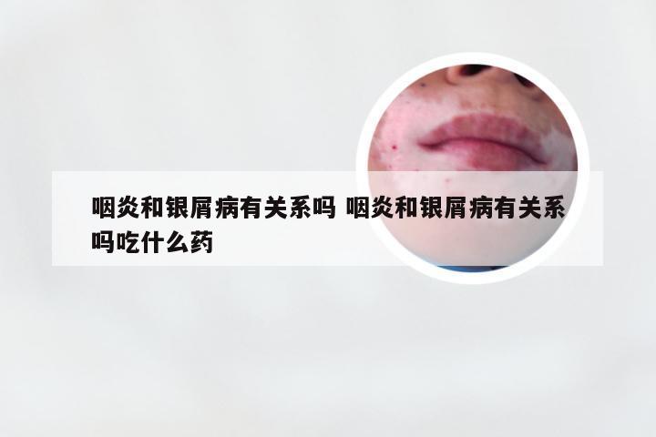 咽炎和银屑病有关系吗 咽炎和银屑病有关系吗吃什么药