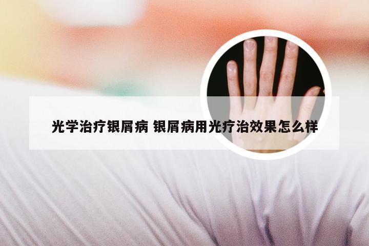 光学治疗银屑病 银屑病用光疗治效果怎么样