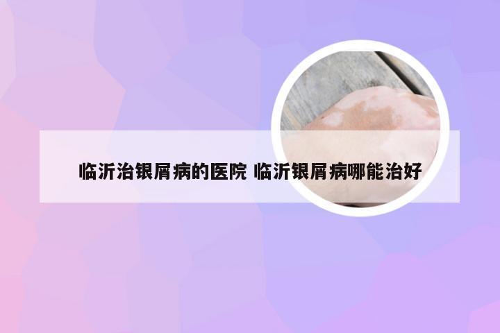 临沂治银屑病的医院 临沂银屑病哪能治好