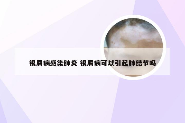 银屑病感染肺炎 银屑病可以引起肺结节吗