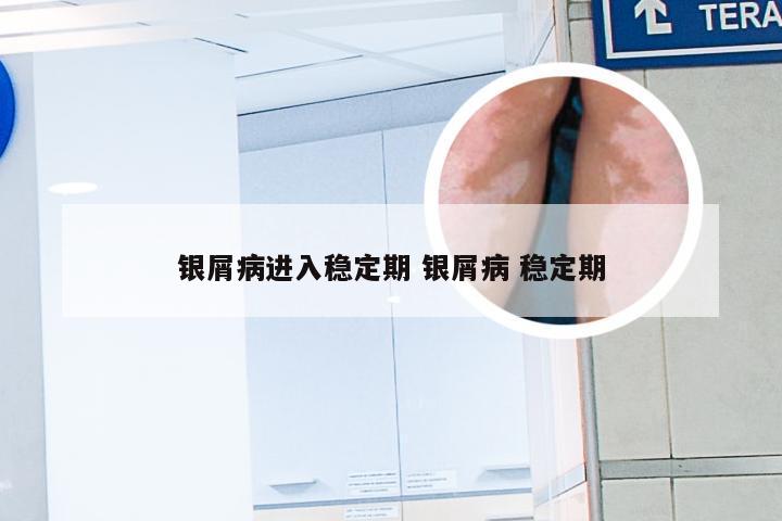 银屑病进入稳定期 银屑病 稳定期