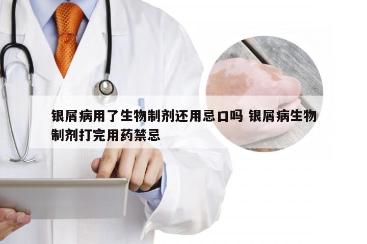 银屑病用了生物制剂还用忌口吗 银屑病生物制剂打完用药禁忌