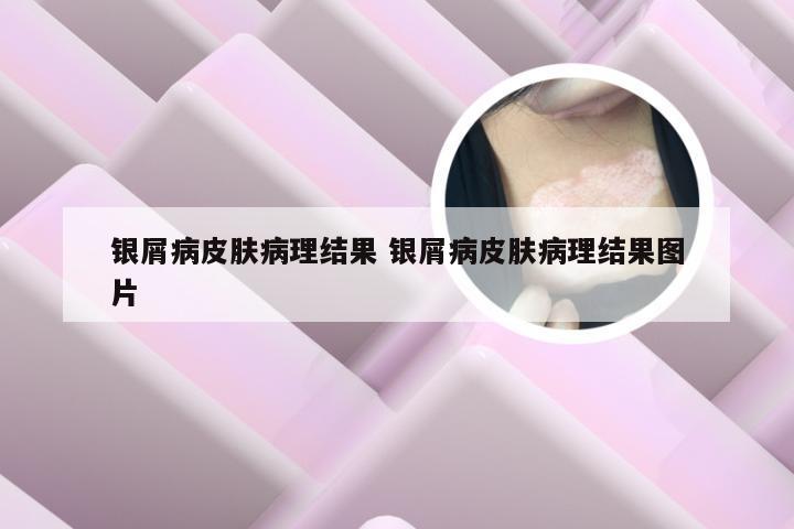 银屑病皮肤病理结果 银屑病皮肤病理结果图片