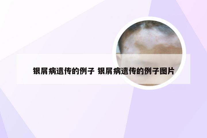 银屑病遗传的例子 银屑病遗传的例子图片