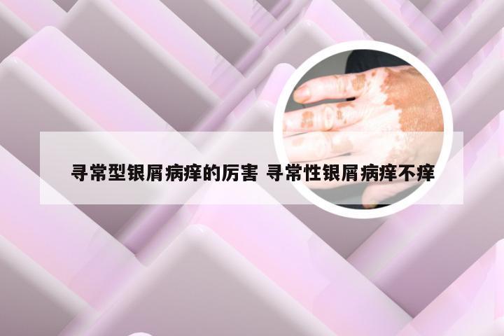 寻常型银屑病痒的厉害 寻常性银屑病痒不痒