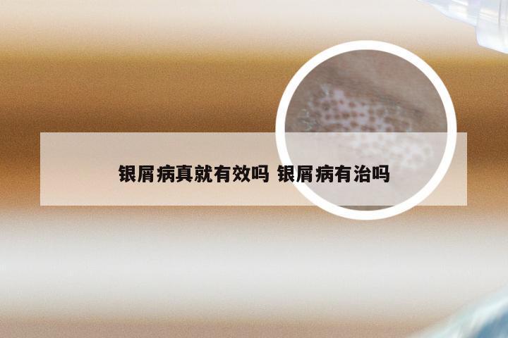 银屑病真就有效吗 银屑病有治吗