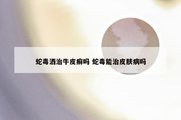 蛇毒洒治牛皮癣吗 蛇毒能治皮肤病吗