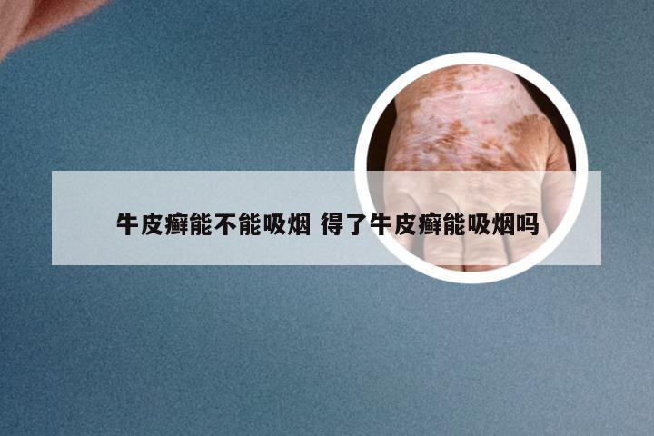 牛皮癣能不能吸烟 得了牛皮癣能吸烟吗