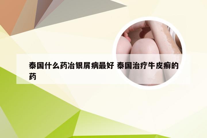 泰国什么药冶银屑病最好 泰国治疗牛皮癣的药