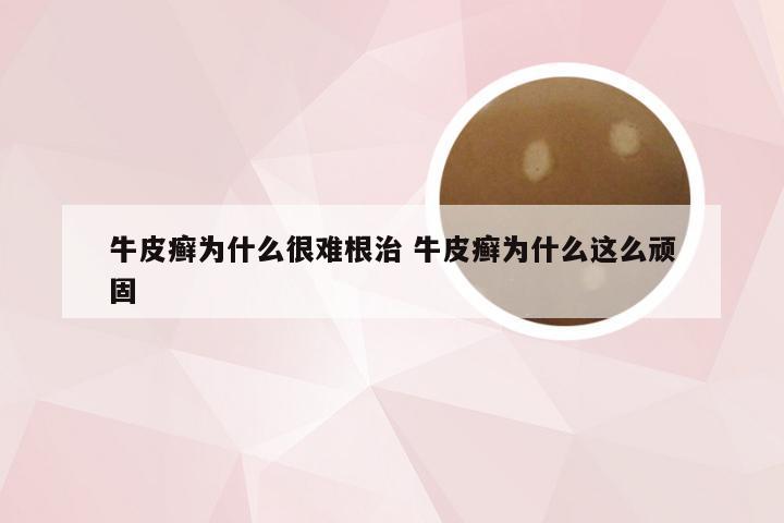 牛皮癣为什么很难根治 牛皮癣为什么这么顽固