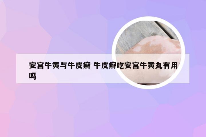 安宫牛黄与牛皮癣 牛皮癣吃安宫牛黄丸有用吗