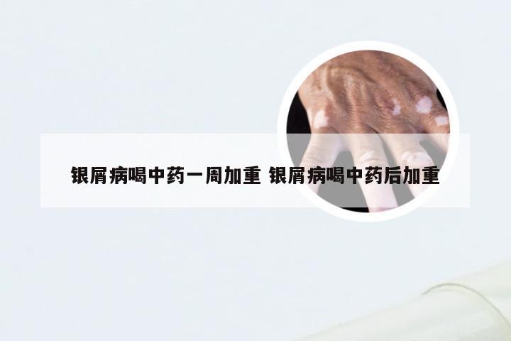 银屑病喝中药一周加重 银屑病喝中药后加重
