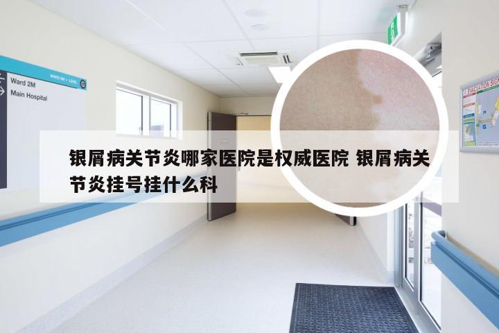 银屑病关节炎哪家医院是权威医院 银屑病关节炎挂号挂什么科