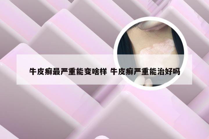 牛皮癣最严重能变啥样 牛皮癣严重能治好吗