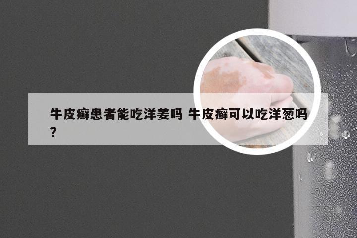 牛皮癣患者能吃洋姜吗 牛皮癣可以吃洋葱吗?