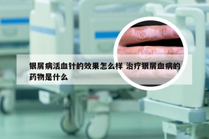 银屑病活血针的效果怎么样 治疗银屑血病的药物是什么