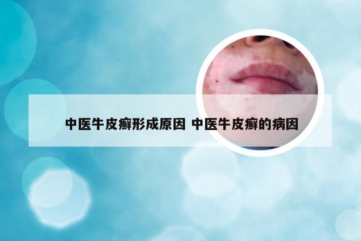 中医牛皮癣形成原因 中医牛皮癣的病因
