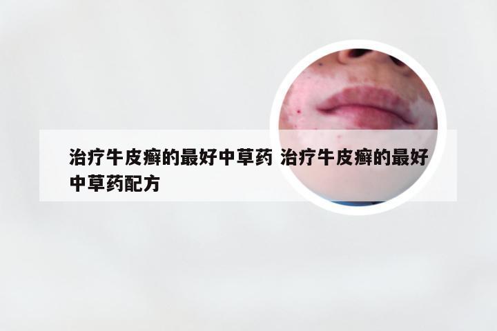 治疗牛皮癣的最好中草药 治疗牛皮癣的最好中草药配方