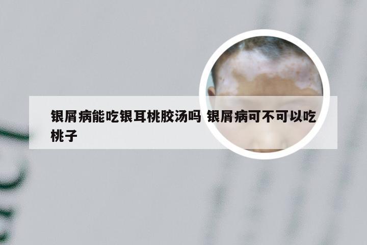 银屑病能吃银耳桃胶汤吗 银屑病可不可以吃桃子