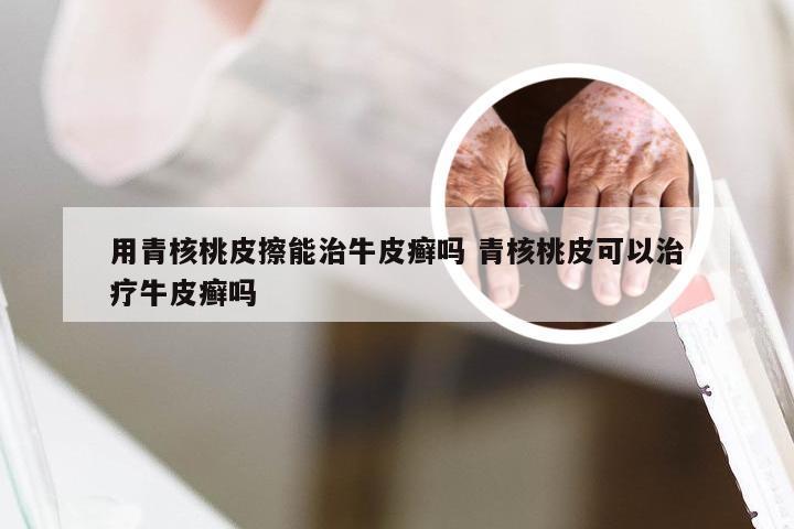 用青核桃皮擦能治牛皮癣吗 青核桃皮可以治疗牛皮癣吗