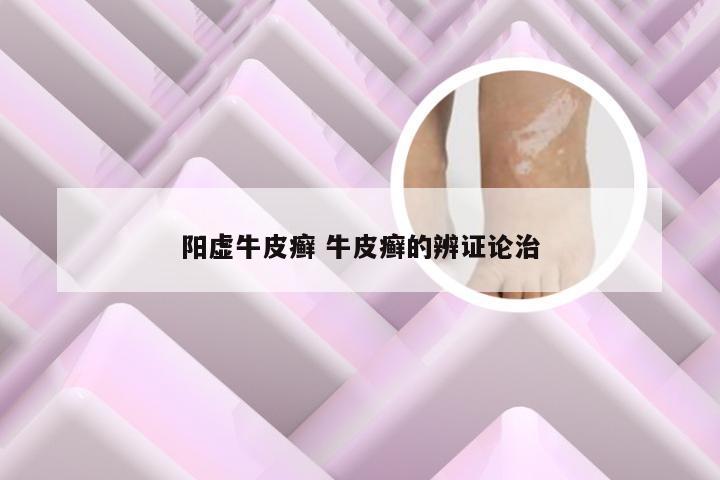 阳虚牛皮癣 牛皮癣的辨证论治