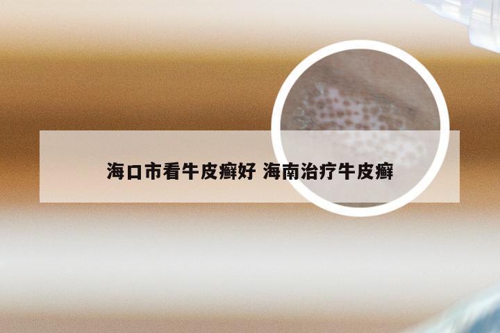 海口市看牛皮癣好 海南治疗牛皮癣