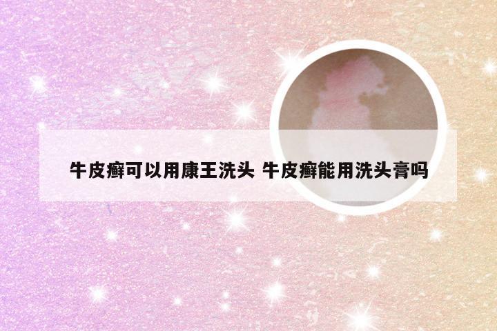 牛皮癣可以用康王洗头 牛皮癣能用洗头膏吗