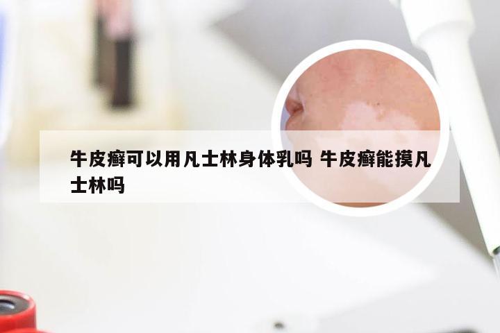 牛皮癣可以用凡士林身体乳吗 牛皮癣能摸凡士林吗