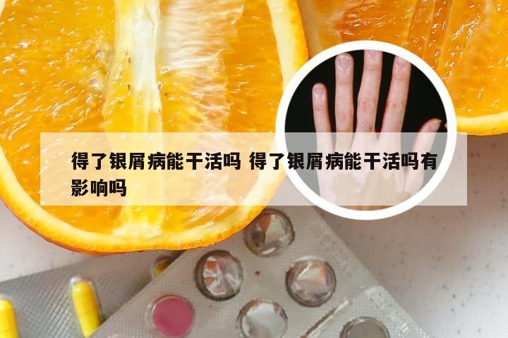 得了银屑病能干活吗 得了银屑病能干活吗有影响吗