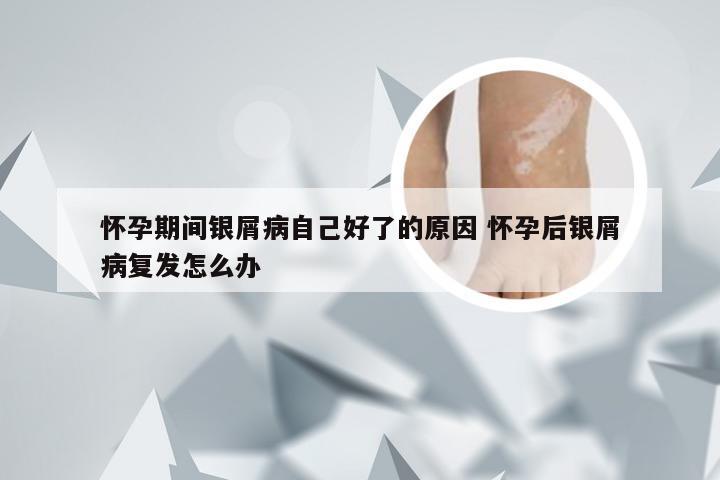 怀孕期间银屑病自己好了的原因 怀孕后银屑病复发怎么办